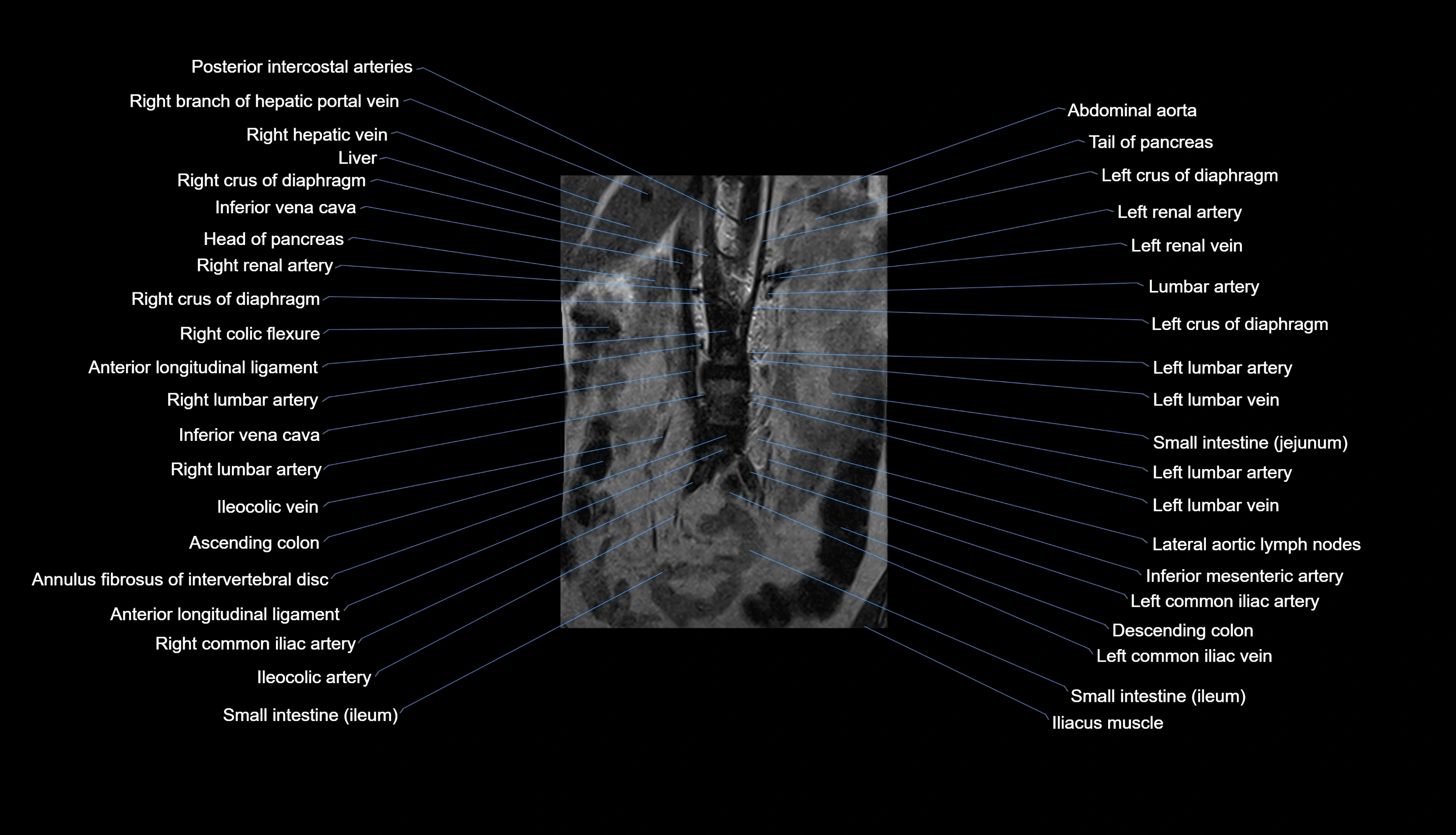 MRI lumbar spine labelled coronal cross sectional anatomy 3T radiology-img-00001-00004.webp